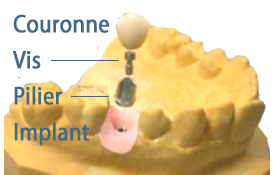 IMPLANT dentaire